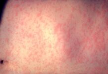 Measles alert